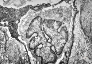 M, 70y. | mycosis fungoides - Sézary cell M, 70y. | mycosis fungoides - Sézary cell